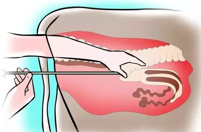 養?？破眨耗概Ｉ诚到y與人工輸精